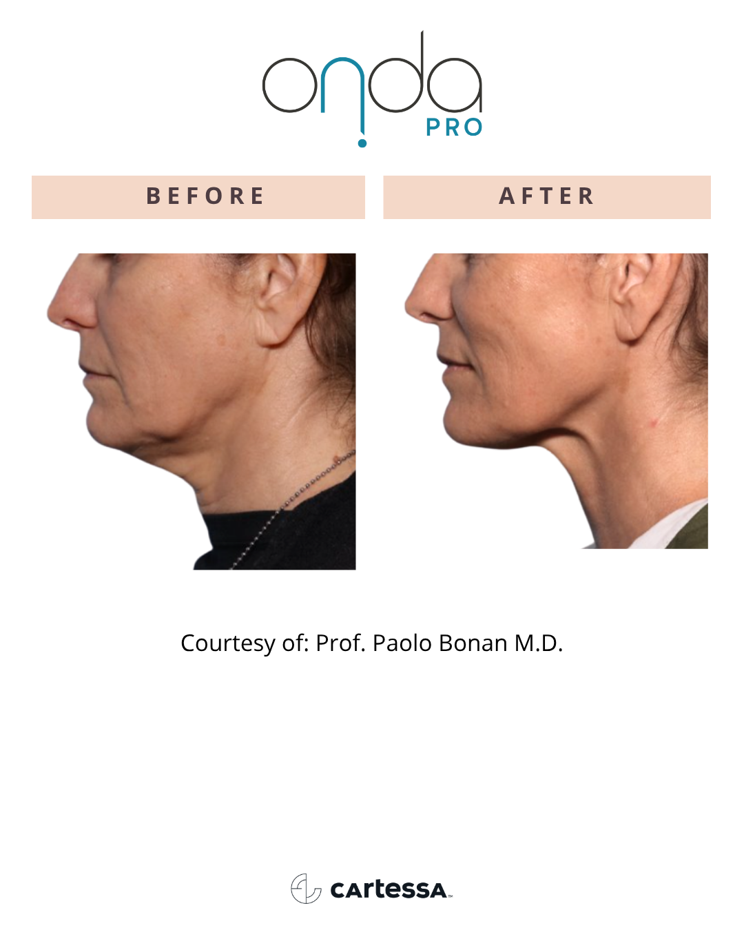 ONDA PRO before and after face profile contouring at Slater Aesthetics Atlanta