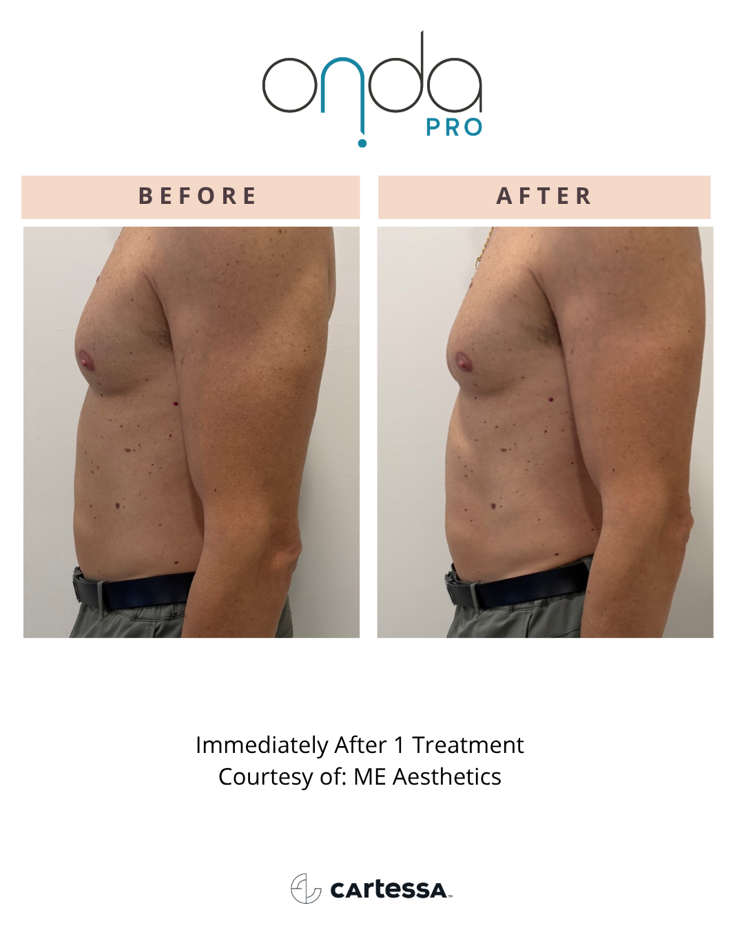 ONDA PRO before and after abdomen contouring at Slater Aesthetics Atlanta