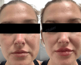 Before and immediately after Restylane Kysse Lip Filler treatment at Slater Aesthetics med spa Atlanta GA showing natural-looking lip enhancement profile view