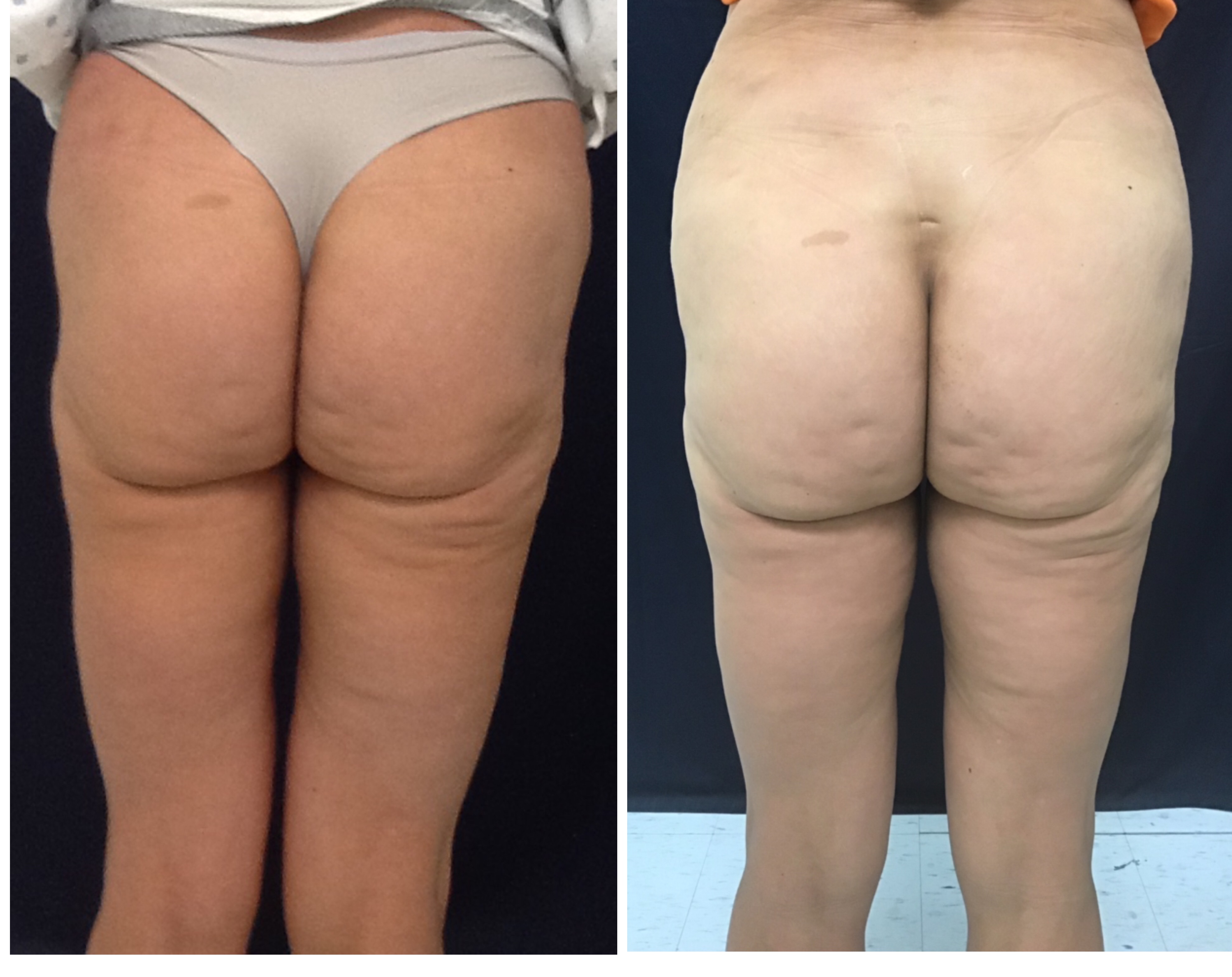 Sculptra butt lift full back view before and after at Slater Aesthetics anti-aging clinic Atlanta showing comprehensive gluteal enhancement