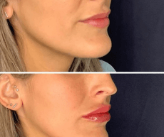 Before and immediately after Restylane Kysse Lip Filler treatment at Slater Aesthetics med spa Atlanta GA showing natural-looking lip enhancement profile view