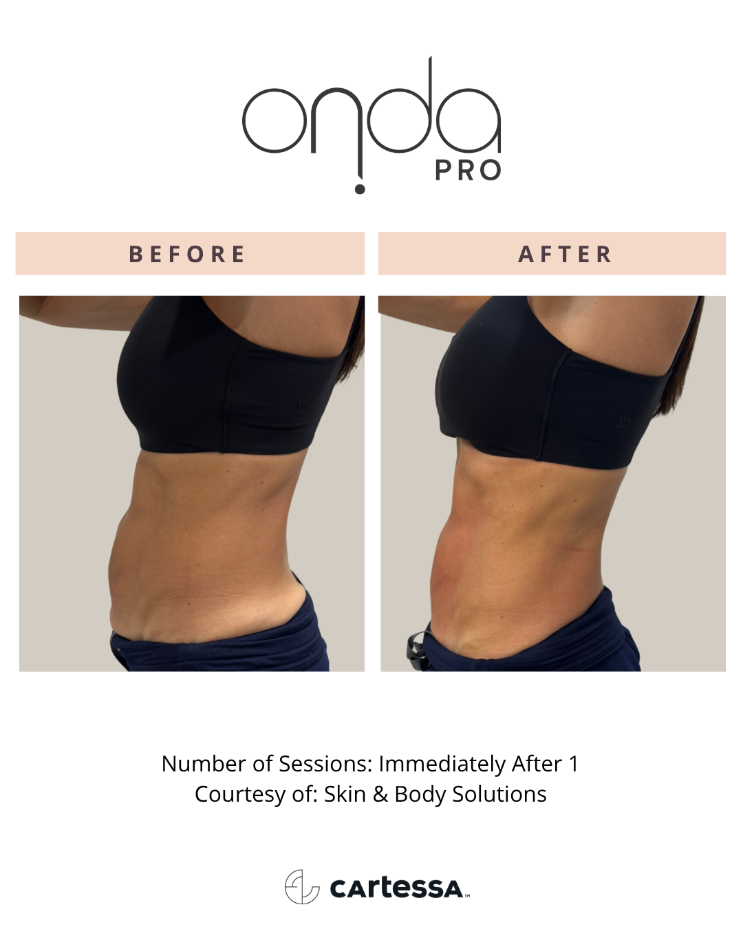 ONDA PRO before and after torso and waist definition at Slater Aesthetics Atlanta