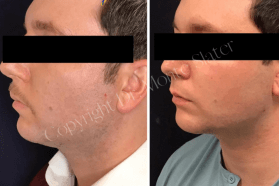 Before and after Restylane Defyne chin and jawline filler treatment by Dr. Monte Slater at Slater Aesthetics med spa Atlanta GA