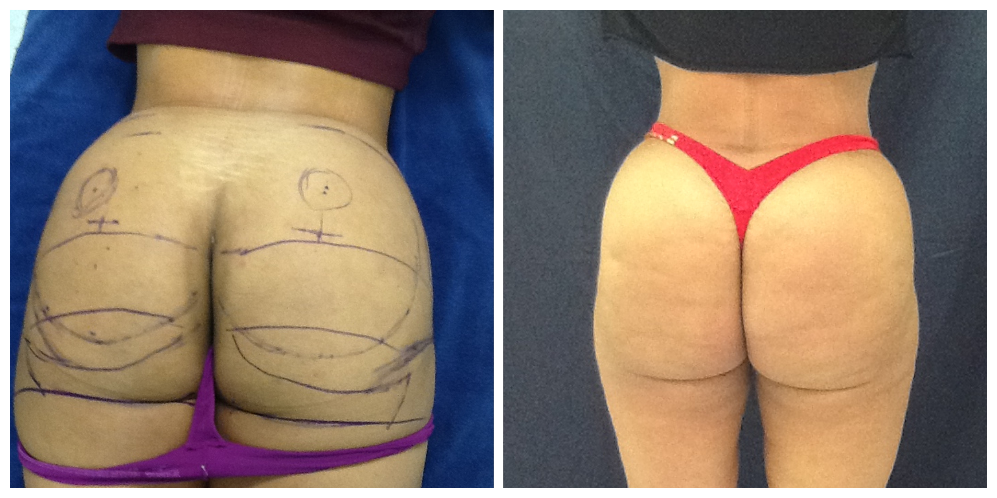 Before and after Sculptra treatment planning and results by Dr. Monte Slater at Slater Aesthetics Atlanta GA showing marked areas and final contour