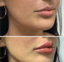 Restylane Kysse before and after results at Slater Aesthetics anti-aging clinic Georgia showing side profile lip enhancement