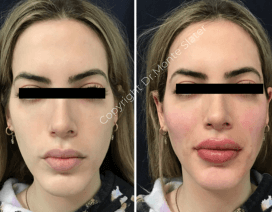 Before and after dermal filler treatment by Dr. Monte Slater at Slater Aesthetics med spa Atlanta GA showing comprehensive facial rejuvenation with Juvederm and Restylane products