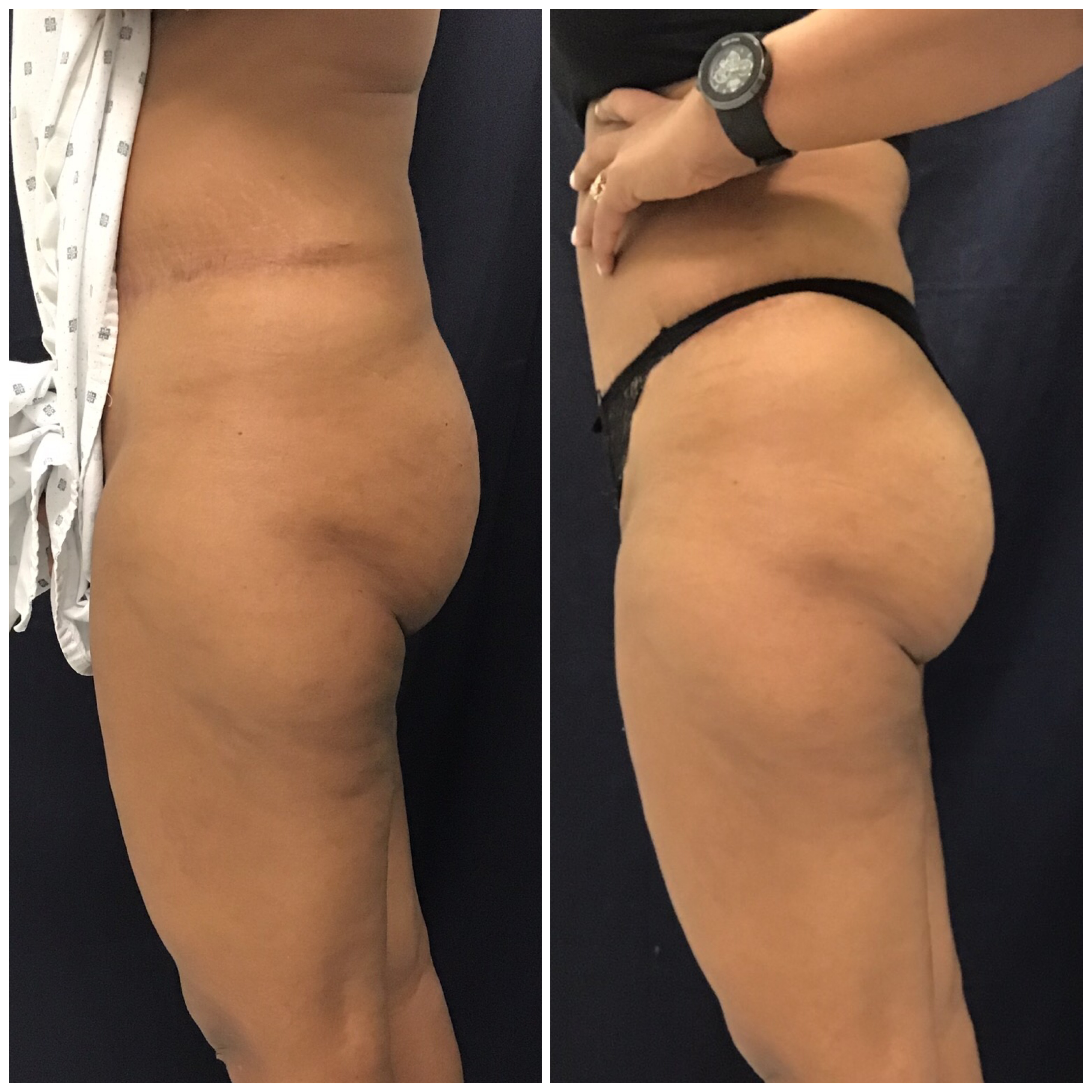 Sculptra butt lift side profile before and after at Slater Aesthetics Atlanta GA showing enhanced buttock projection and thigh contouring