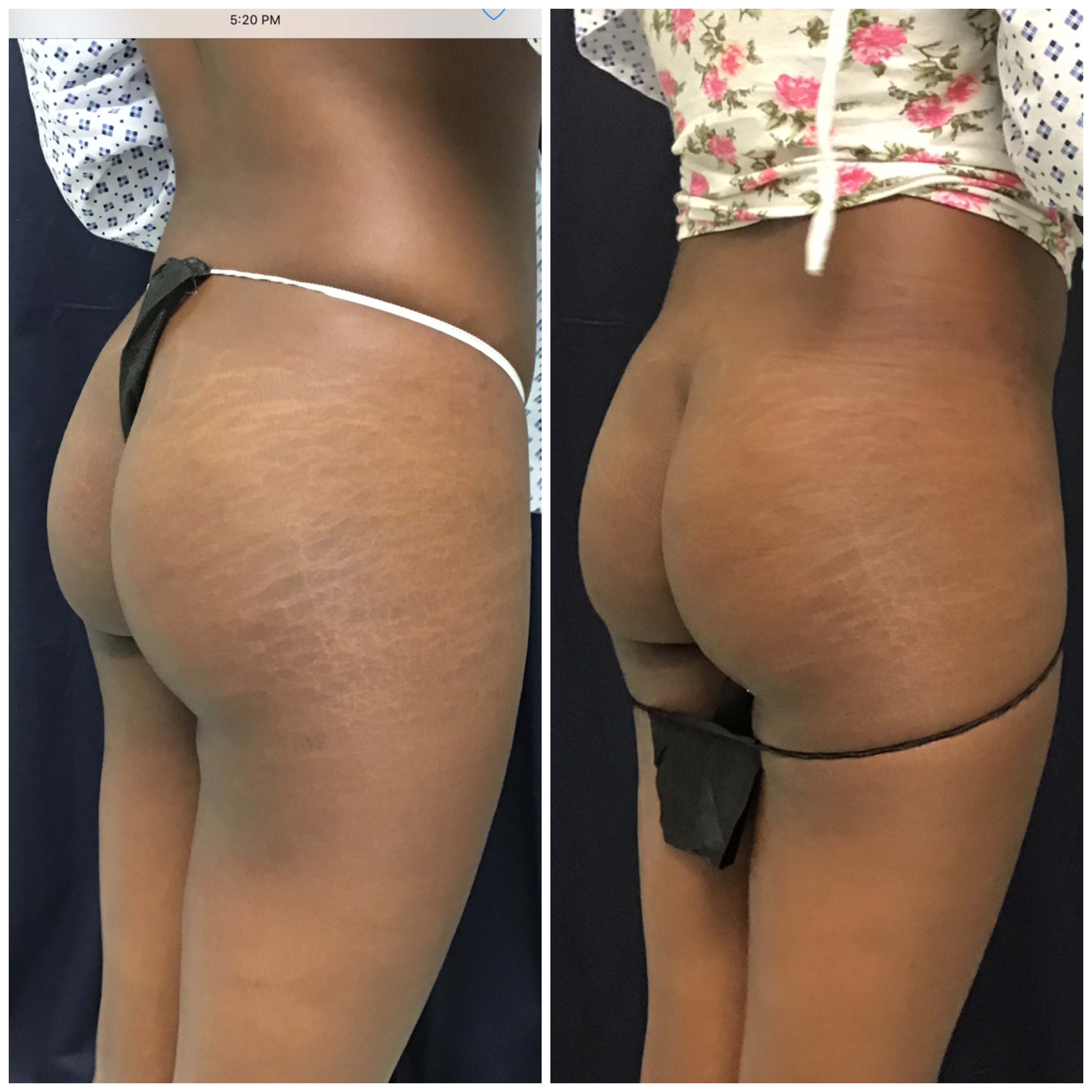 Sculptra body contouring lateral view before and after at Slater Aesthetics anti-aging clinic Atlanta showing buttock and outer thigh enhancement