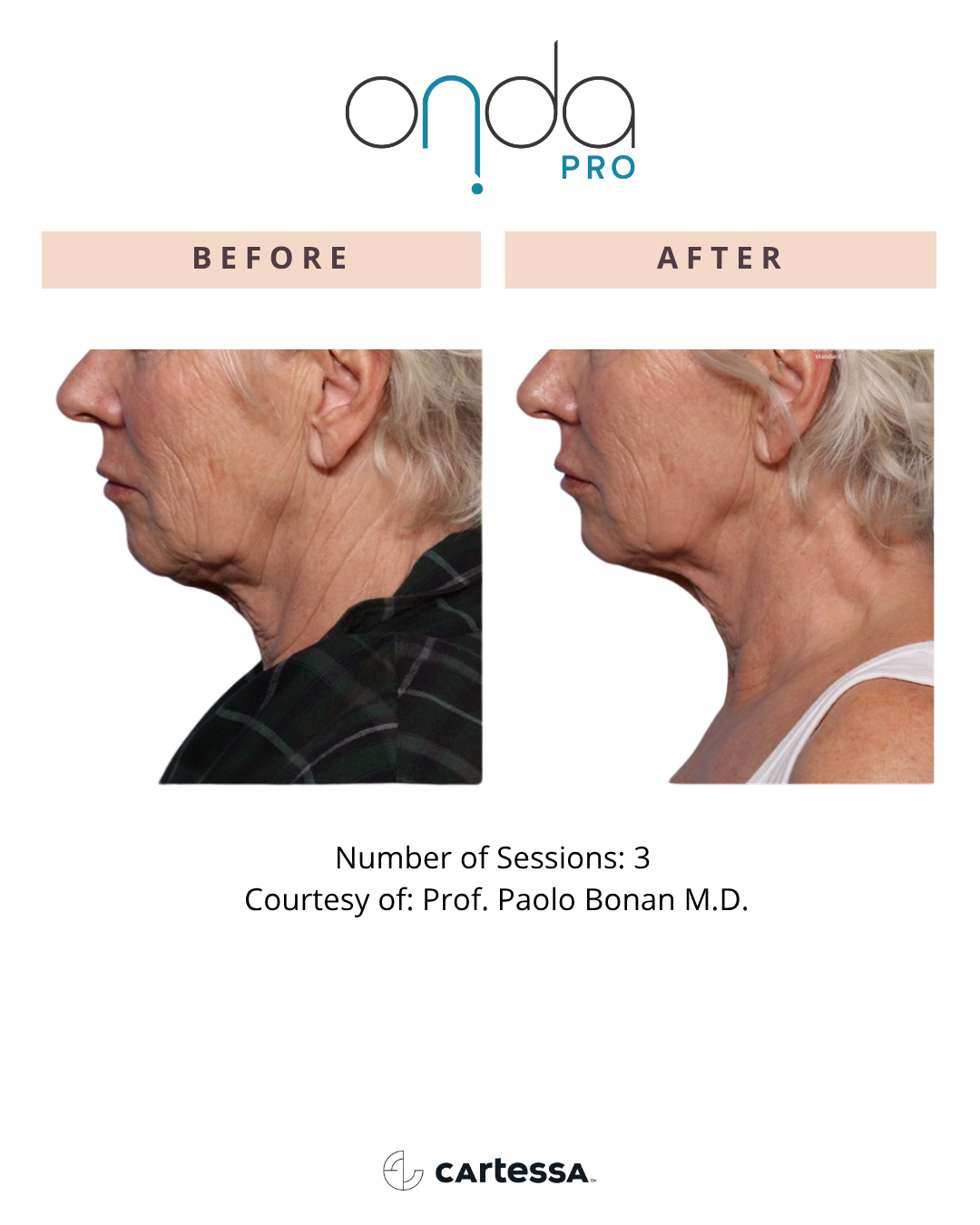 ONDA PRO before and after jawline and neck contouring at Slater Aesthetics Atlanta