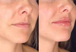 Before and immediately after Restylane Kysse Lip Filler treatment at Slater Aesthetics med spa Atlanta GA showing natural-looking lip enhancement profile view