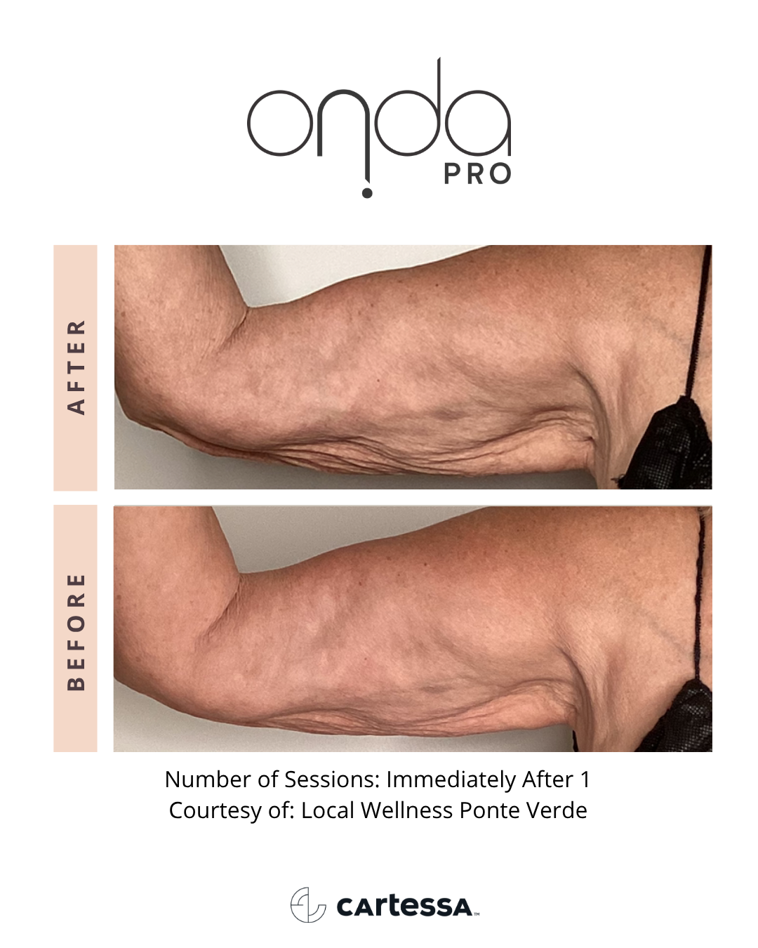 ONDA PRO before and after upper arm tightening at Slater Aesthetics Atlanta