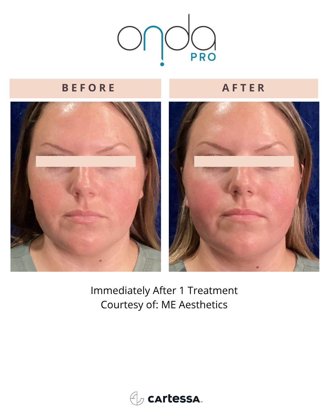 ONDA PRO before and after full facial rejuvenation at Slater Aesthetics Atlanta