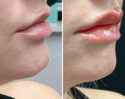 Before and immediately after Restylane Kysse Lip Filler treatment at Slater Aesthetics med spa Atlanta GA showing natural-looking lip enhancement results