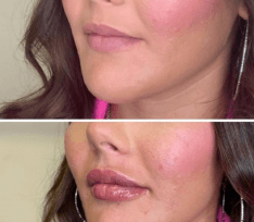 Before and after Restylane Kysse lip augmentation by Dr. Monte Slater at Slater Aesthetics Warner Robins GA showing three-quarter view lip enhancement