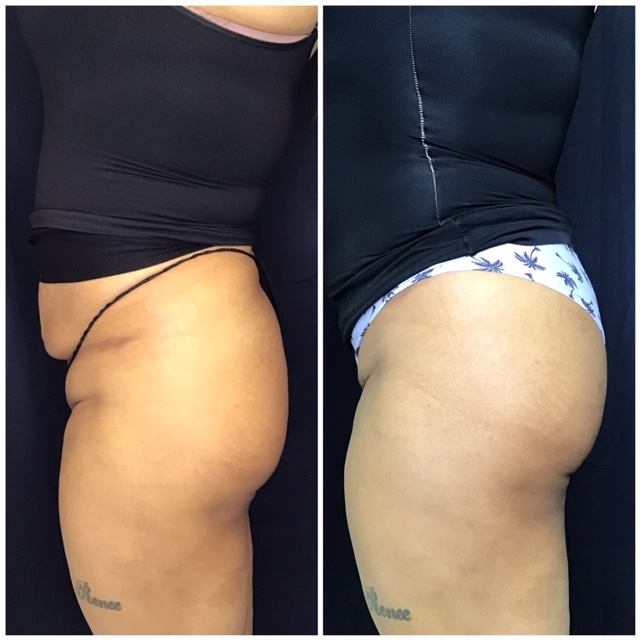 Sculptra butt lift lateral view before and after results by Dr. Monte Slater at Slater Aesthetics Georgia showing improved buttock silhouette and waist-to-hip ratio