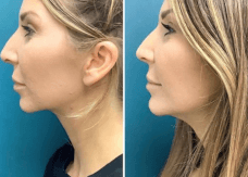 Before and after 2 syringes of Restylane Contour for chin enhancement by Dr. Monte Slater at Slater Aesthetics med spa Atlanta GA