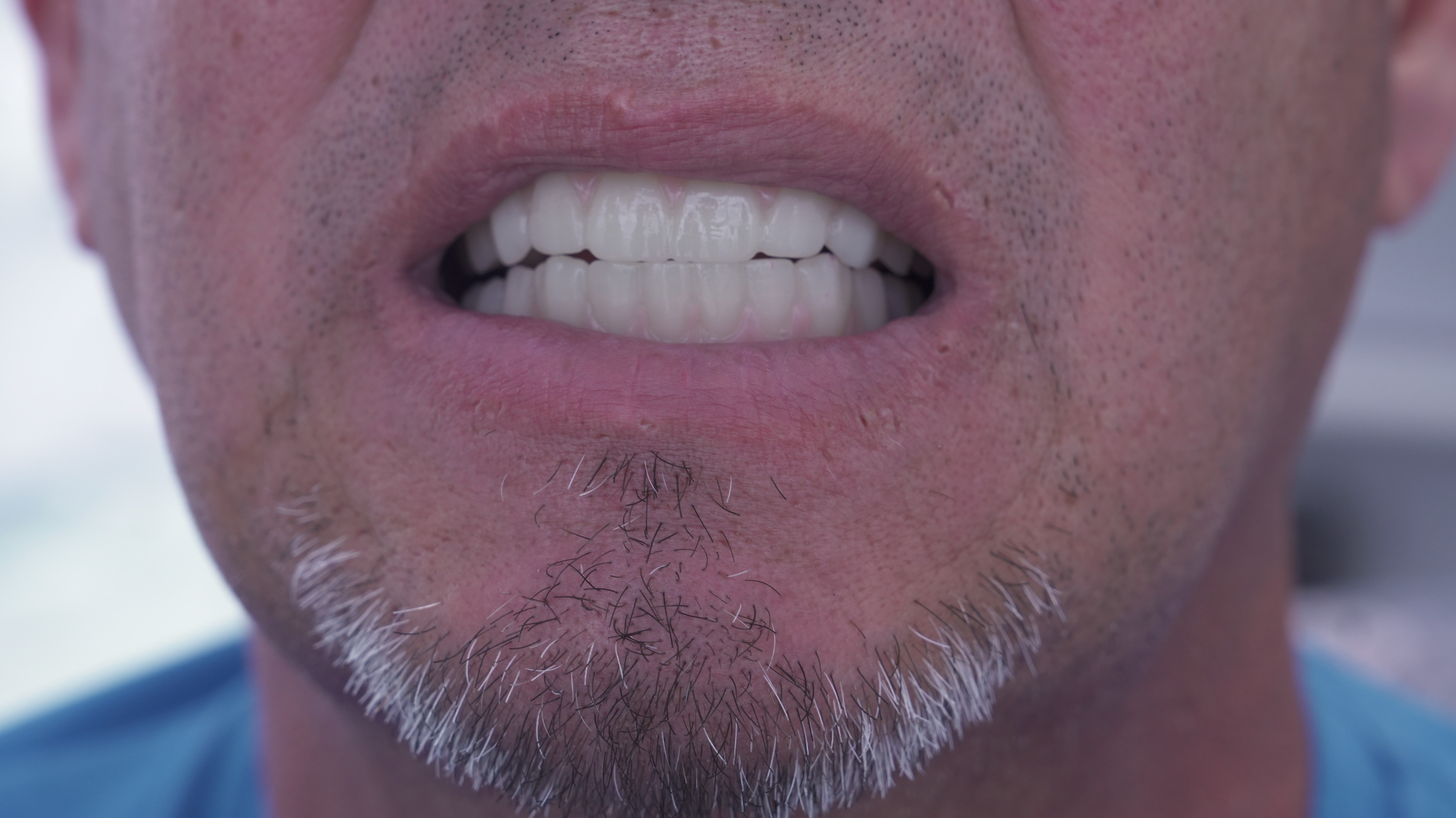 Invisalign Aligners Miami