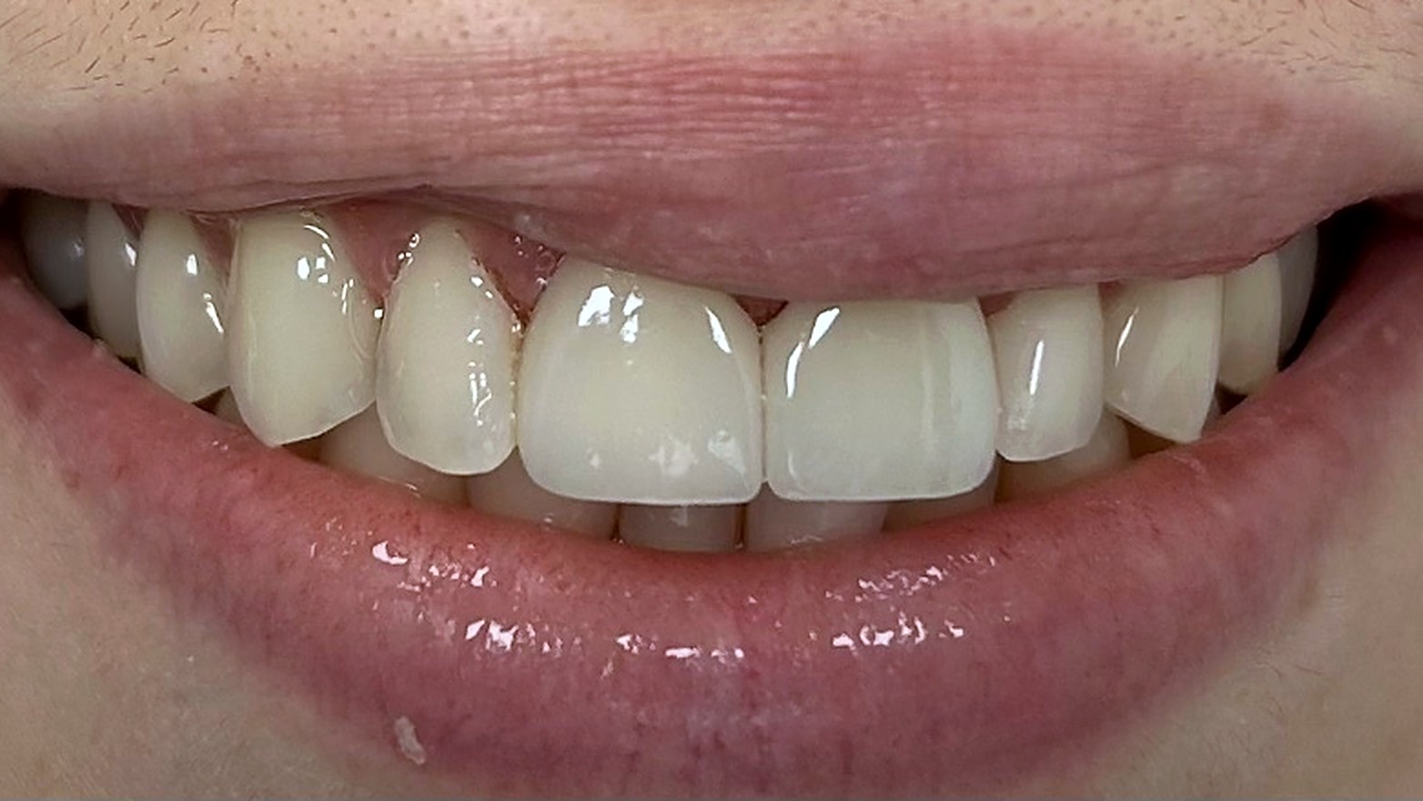 Smile Makeover