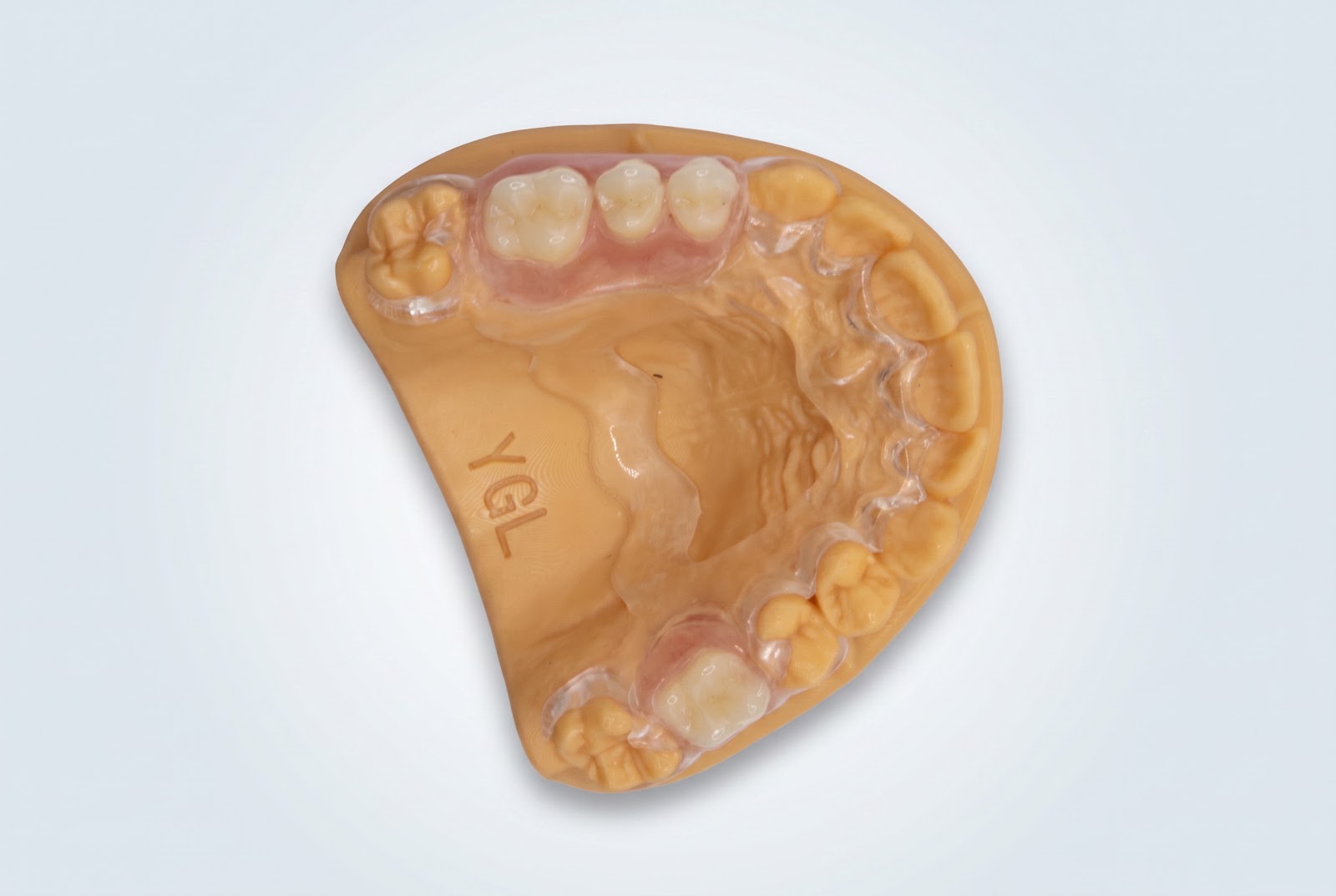 Acrylic Partial with Clear Palatal Design - View 2 | YGL Dental Lab Miami FL
