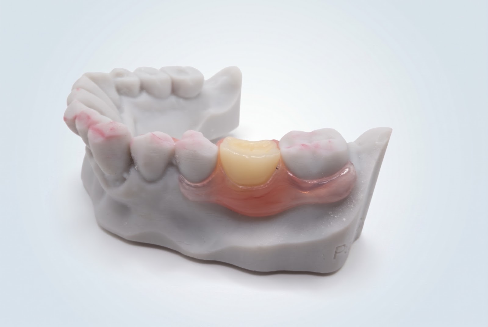 Flex Partial Upper - View 2 | YGL Dental Lab Miami FL