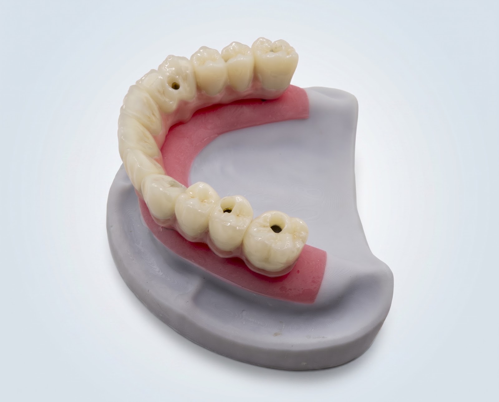All on 6 With Zirconia - View 2 | YGL Dental Lab Miami FL