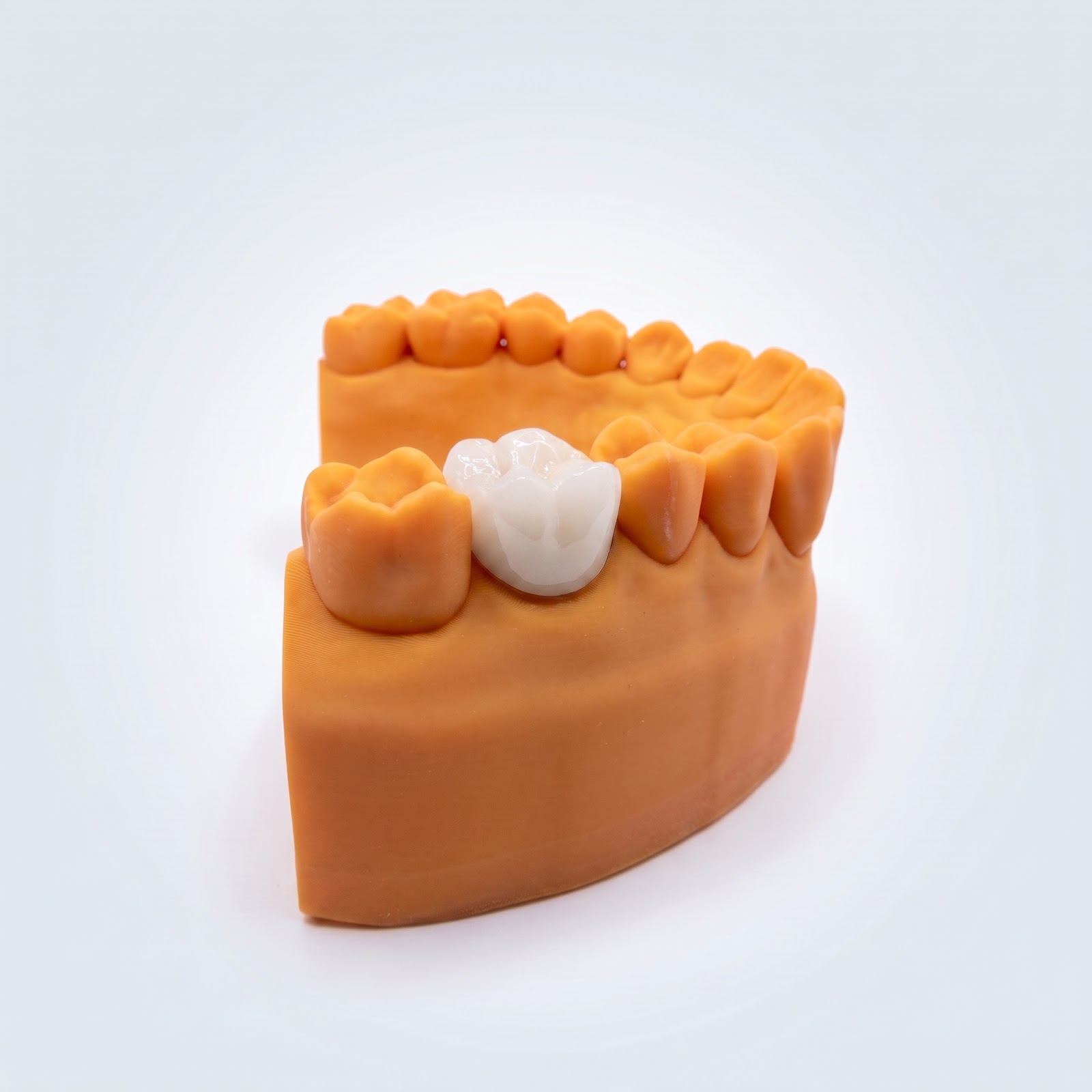 Zirconia Crown - View 1 | YGL Dental Lab Miami FL
