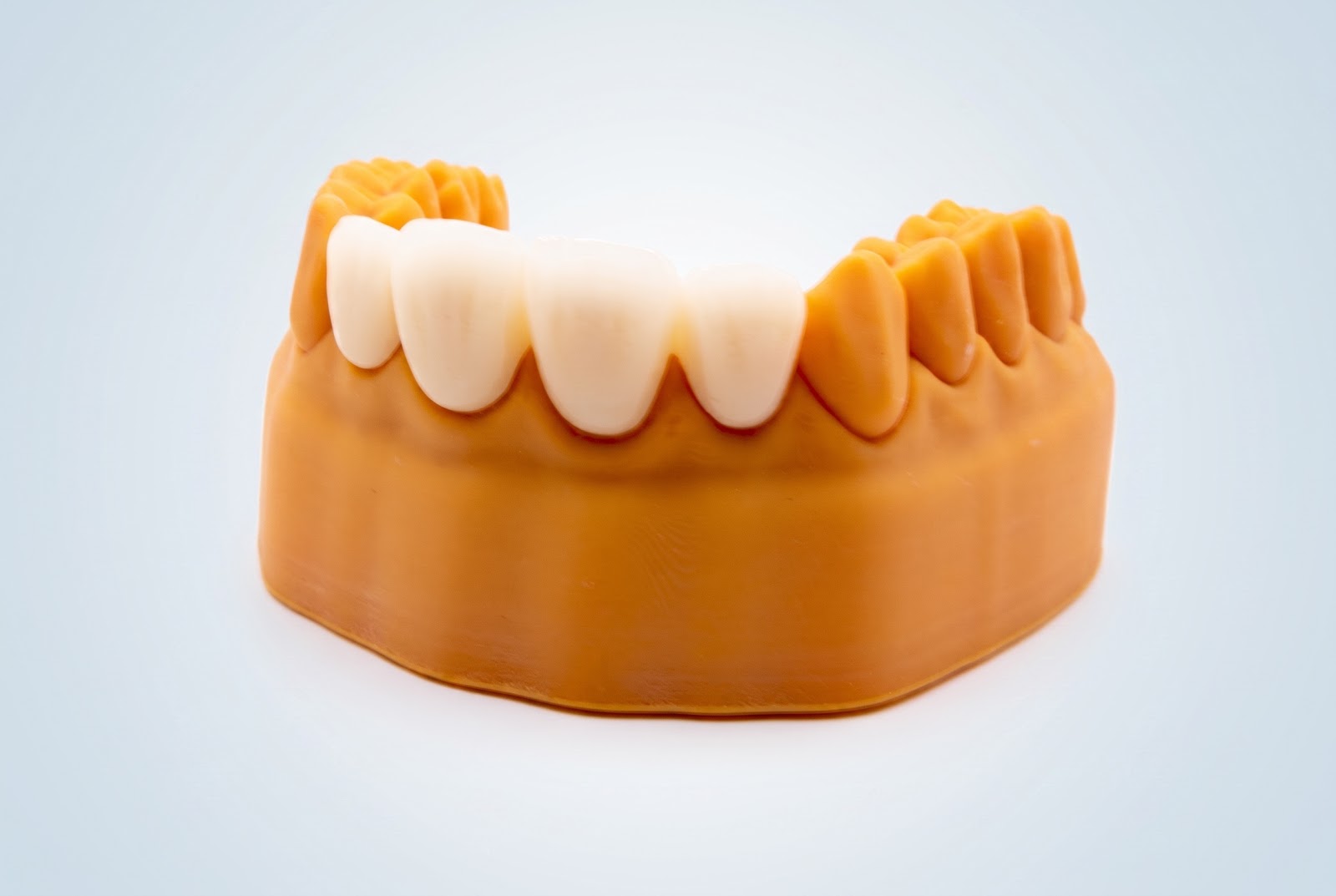 Anteriors Zirconia Crowns - View 1 | YGL Dental Lab Miami FL