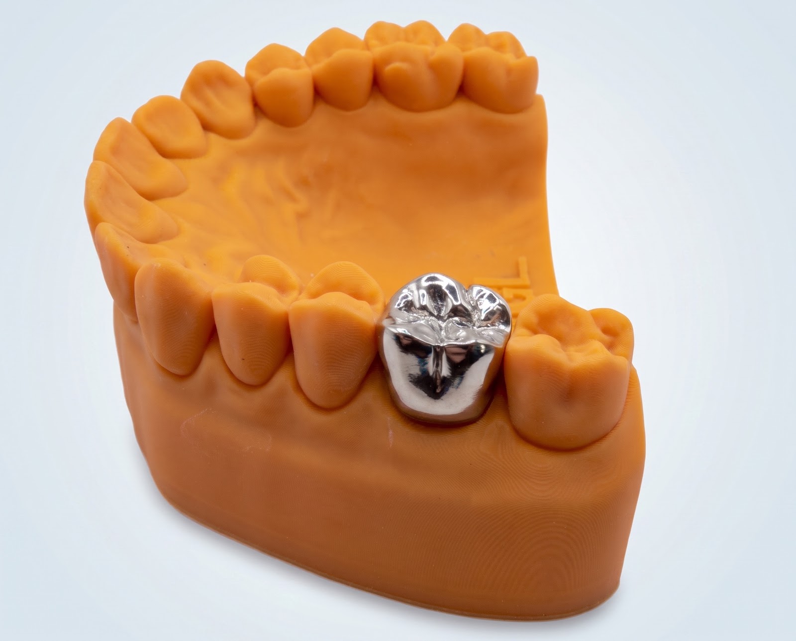 Metal Crown - View 1 | YGL Dental Lab Miami FL