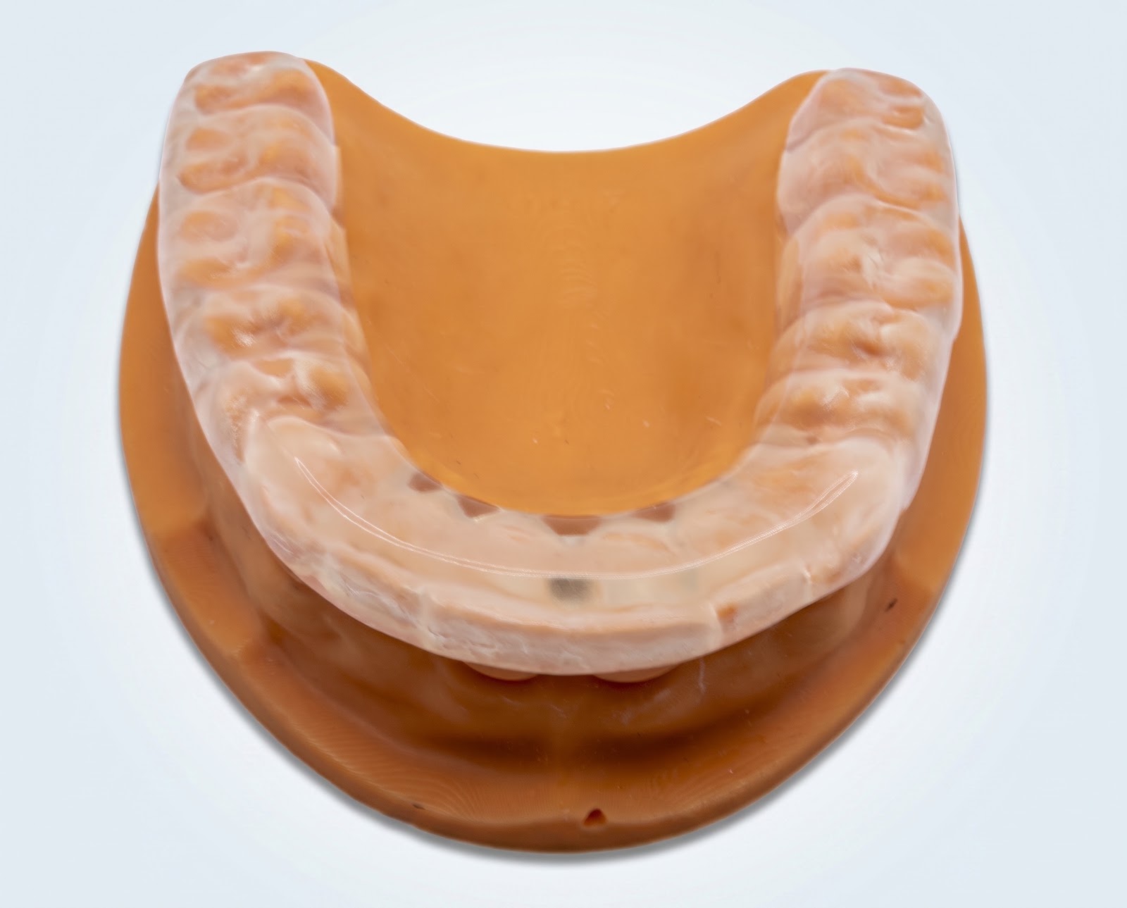 Hard Night Guard - View 2 | YGL Dental Lab Miami FL