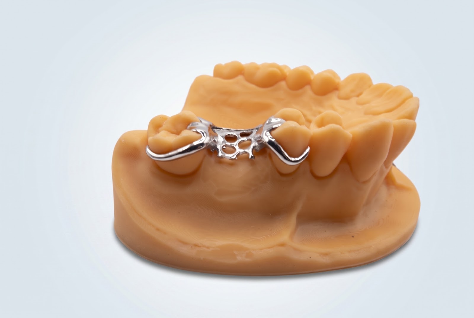 Metal Frame Unilateral - View 2 | YGL Dental Lab Miami FL