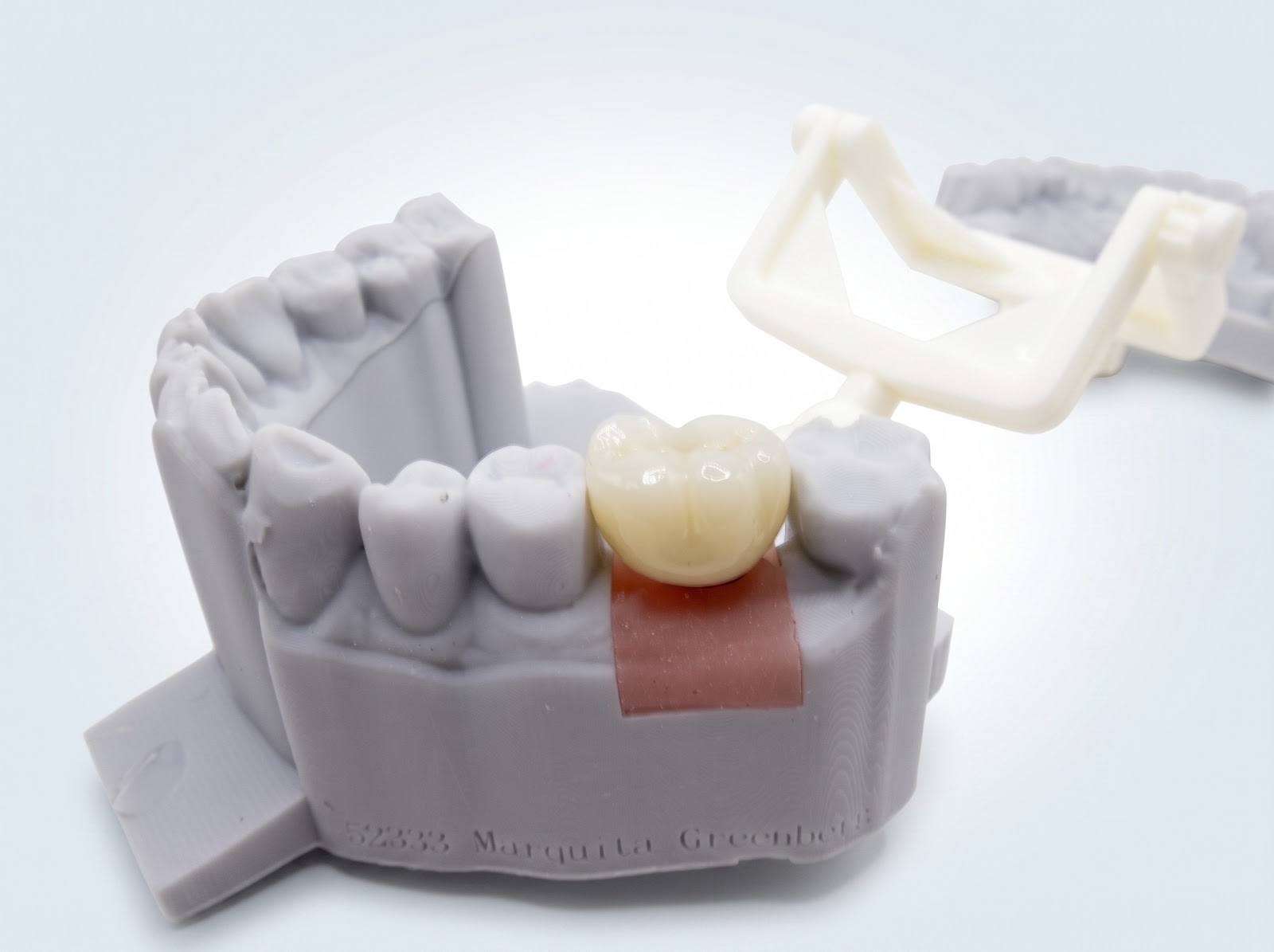 Implant Crown - View 2 | YGL Dental Lab Miami FL
