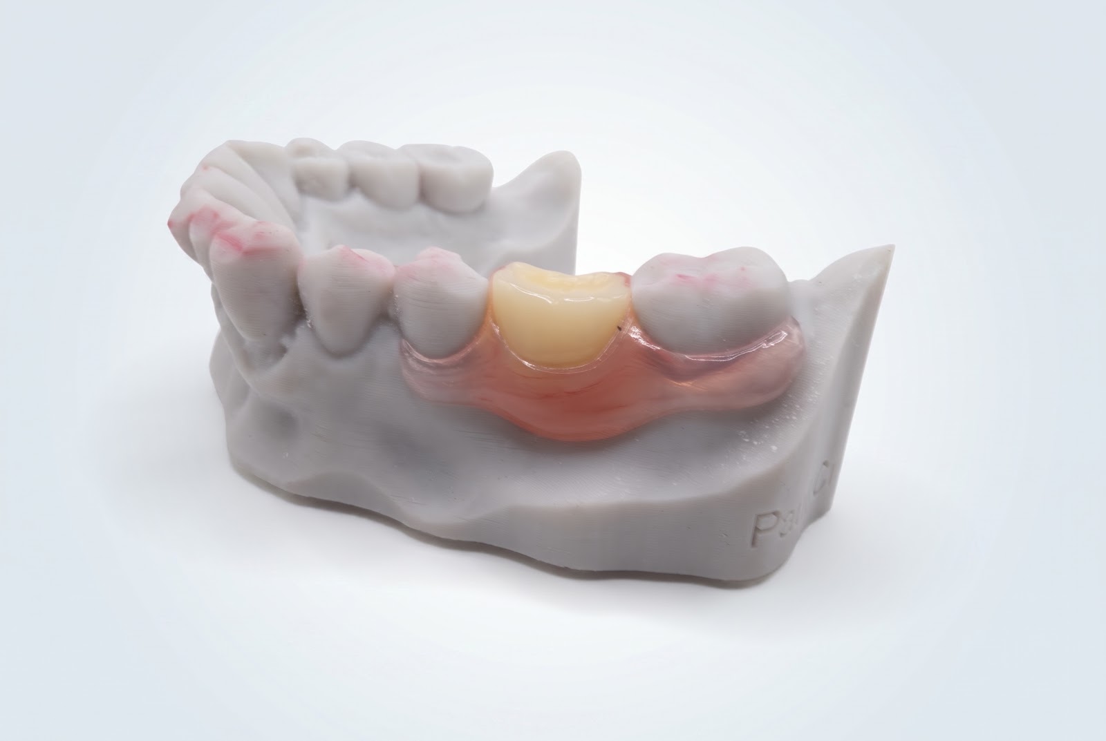 Flex Partial Upper - View 1 | YGL Dental Lab Miami FL