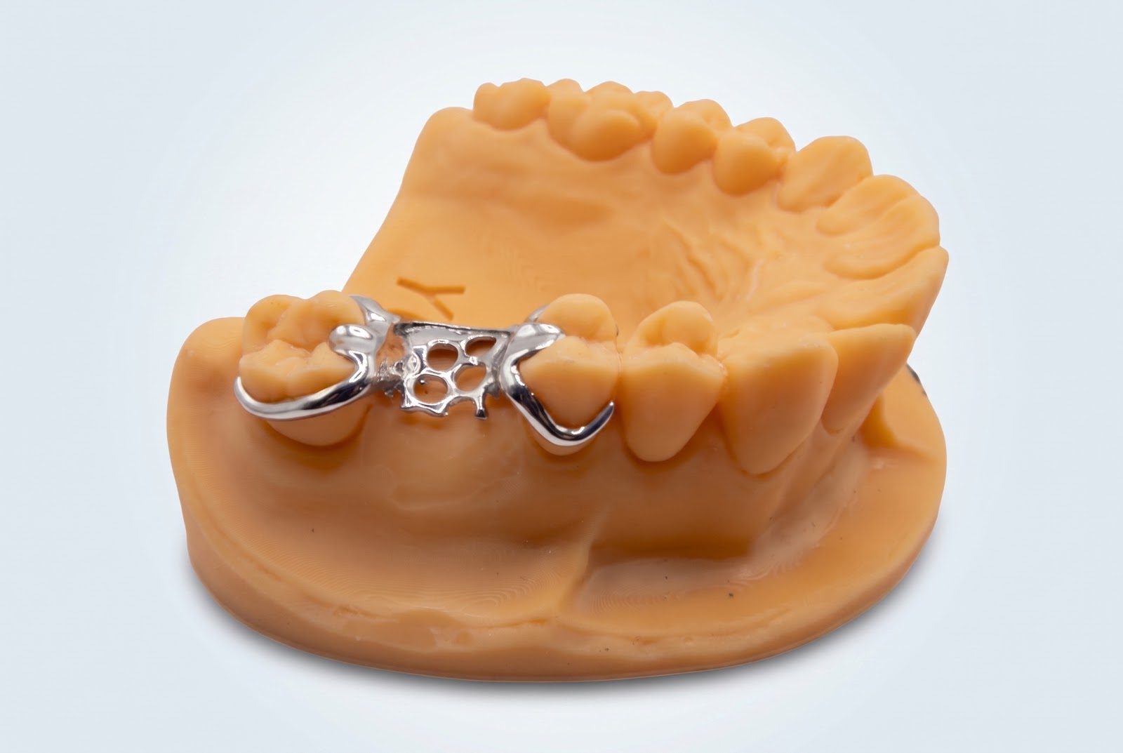 Metal Frame Unilateral - View 1 | YGL Dental Lab Miami FL
