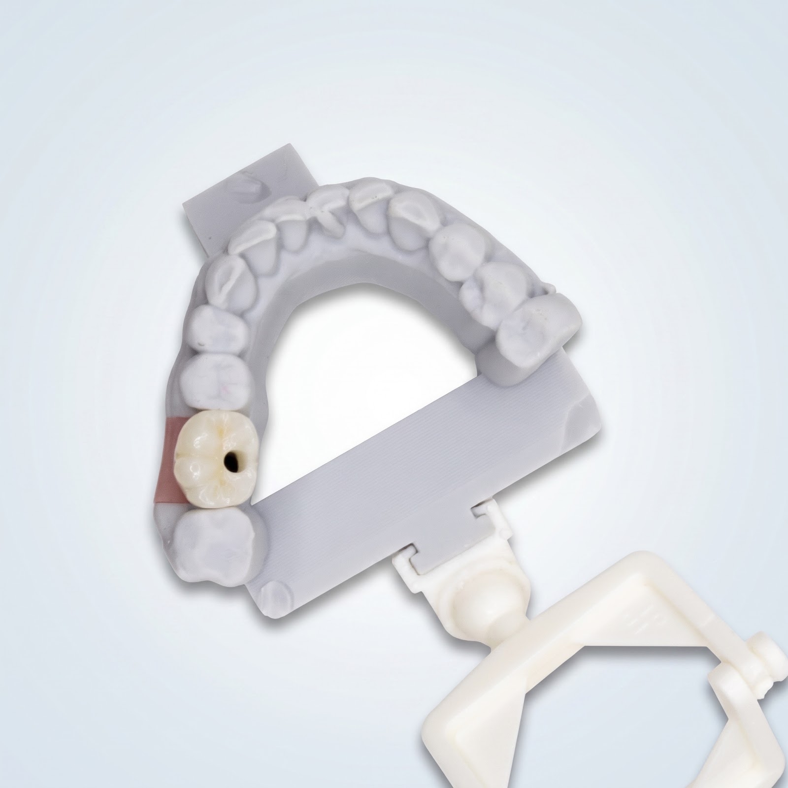 Implant Crown - View 1 | YGL Dental Lab Miami FL