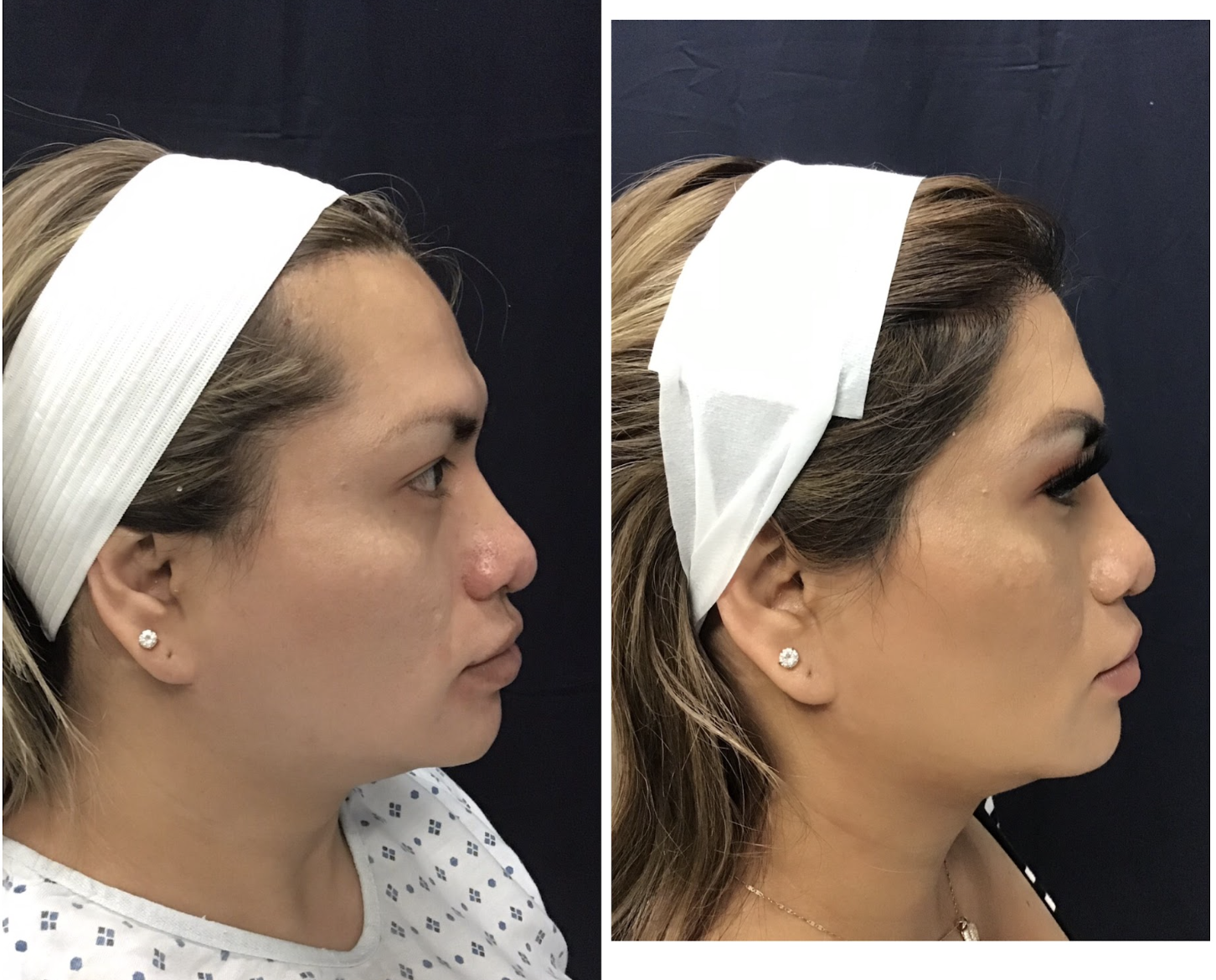 Female Hairline Refinement