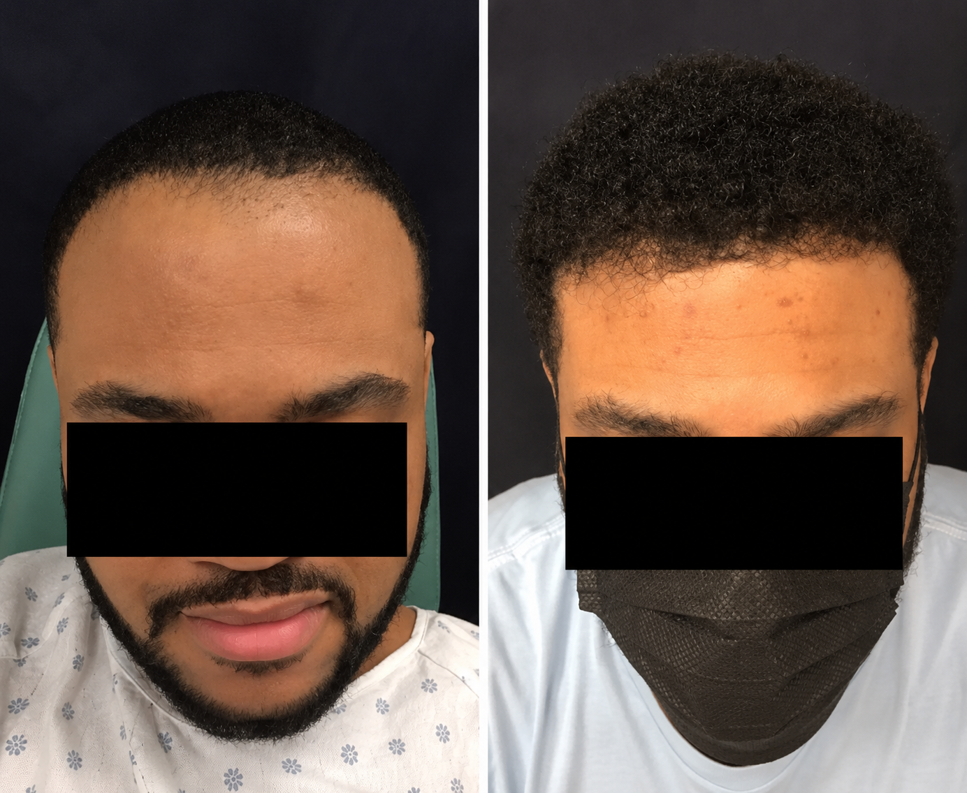 Male Frontal Hairline Restoration