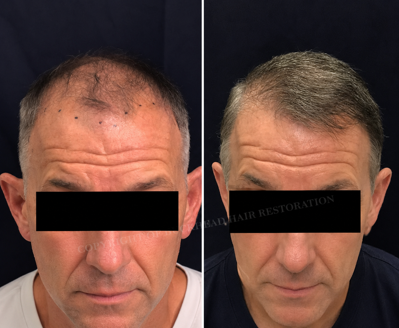 Comprehensive Frontal Hairline Restoration