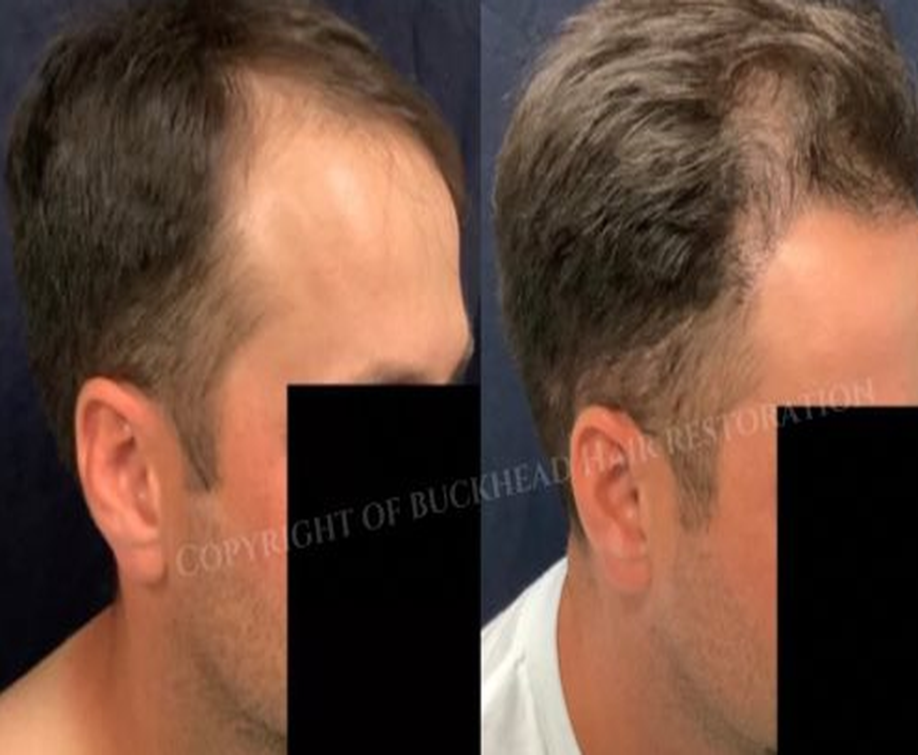 Male Temporal & Frontal Hairline Restoration
