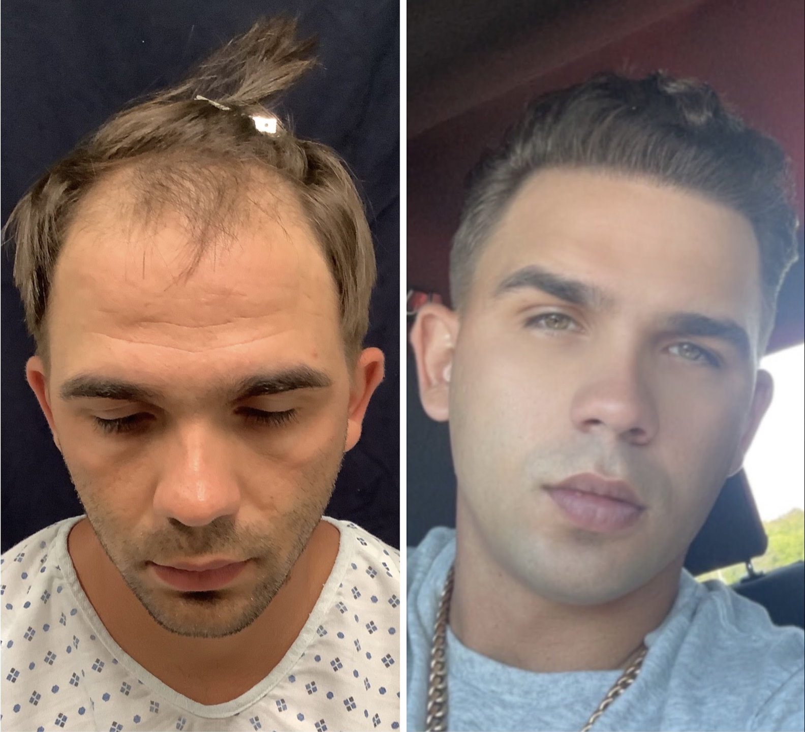 Advanced Hairline Reconstruction