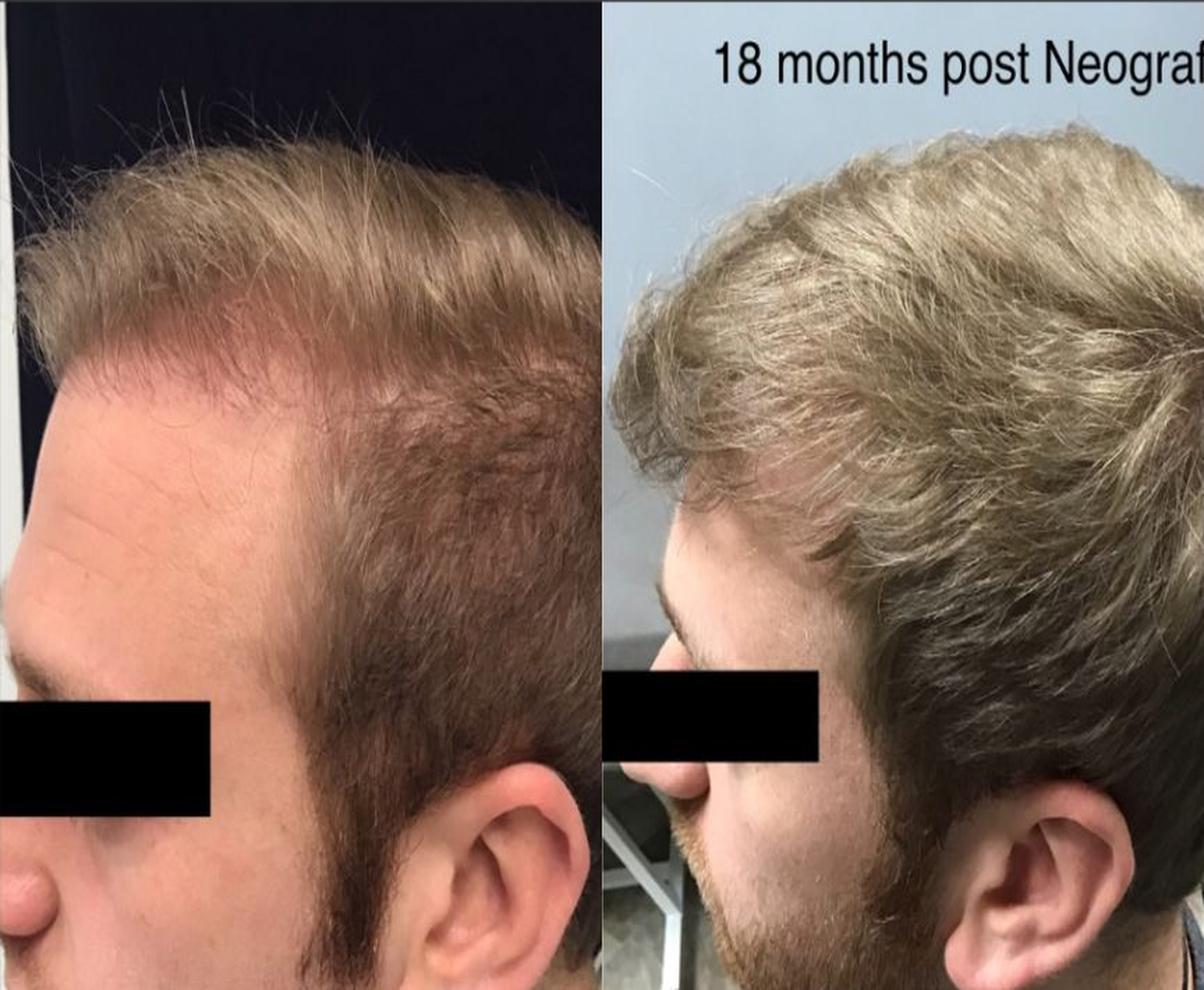 Advanced Frontal & Temporal Restoration