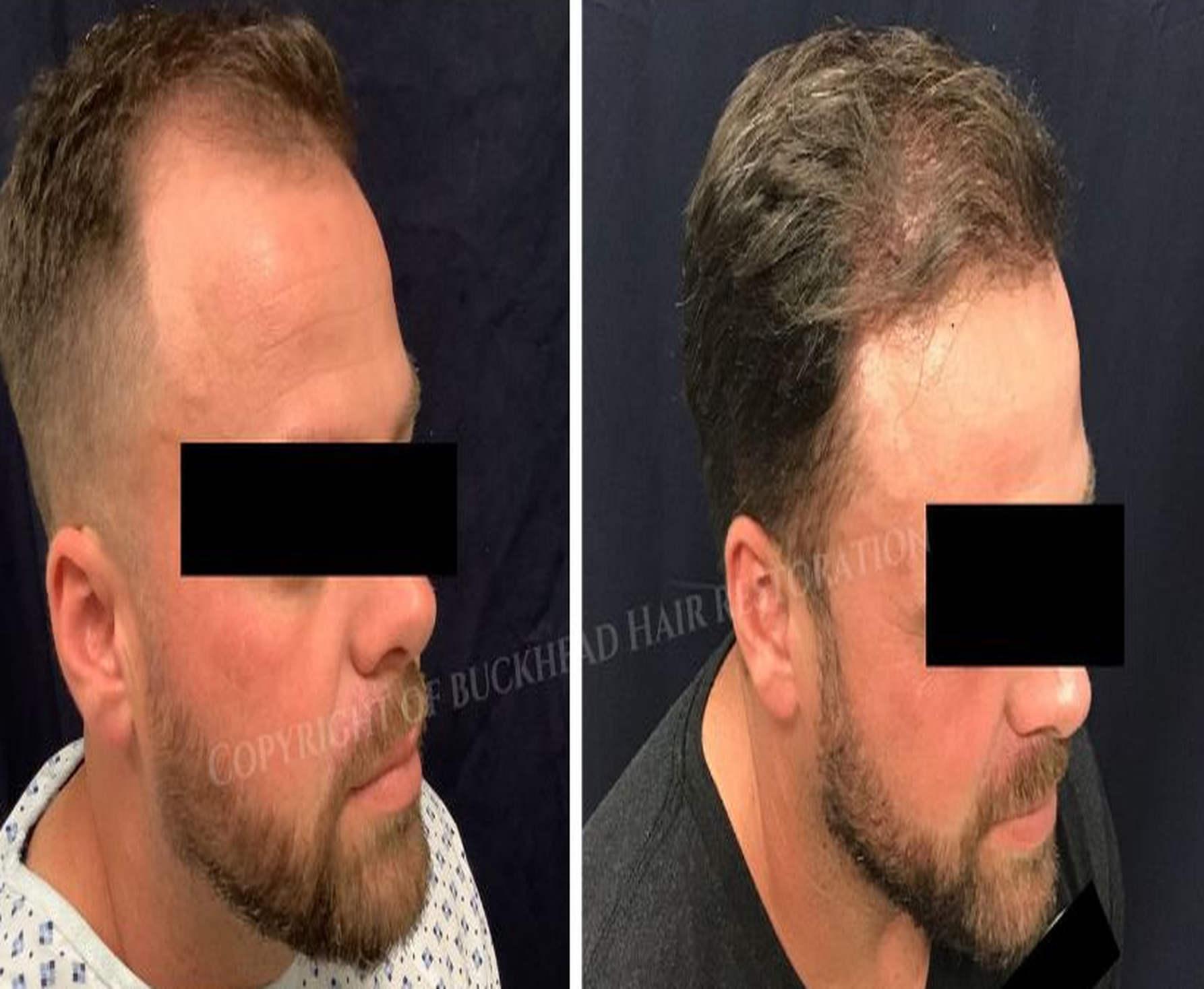 Extensive Frontal & Crown Restoration