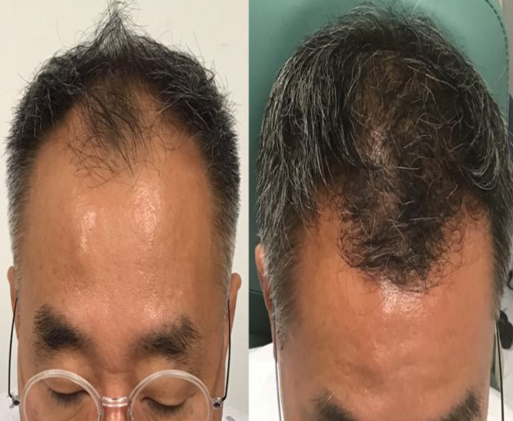 Male Frontal Hairline Restoration