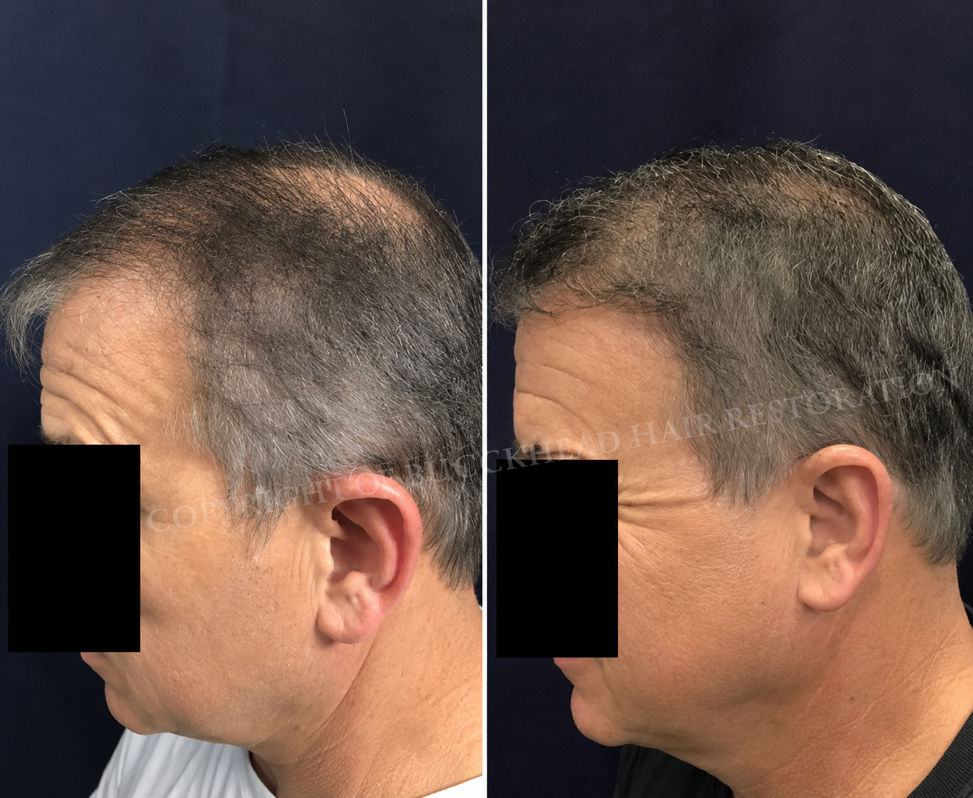 Advanced Density Restoration with PRP