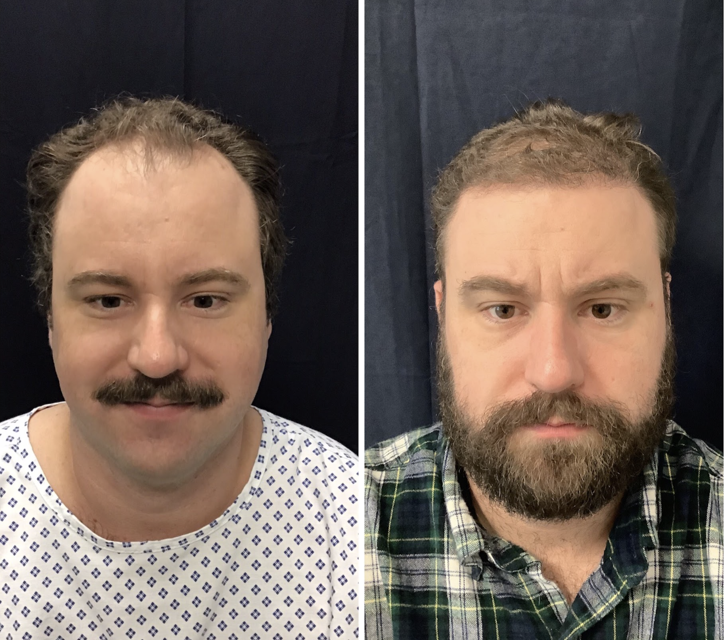 Male Pattern Baldness Restoration