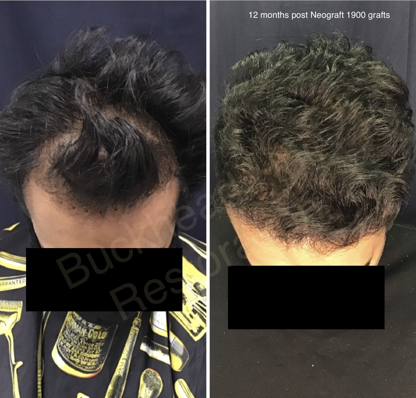 Crown Restoration (1900 Grafts)