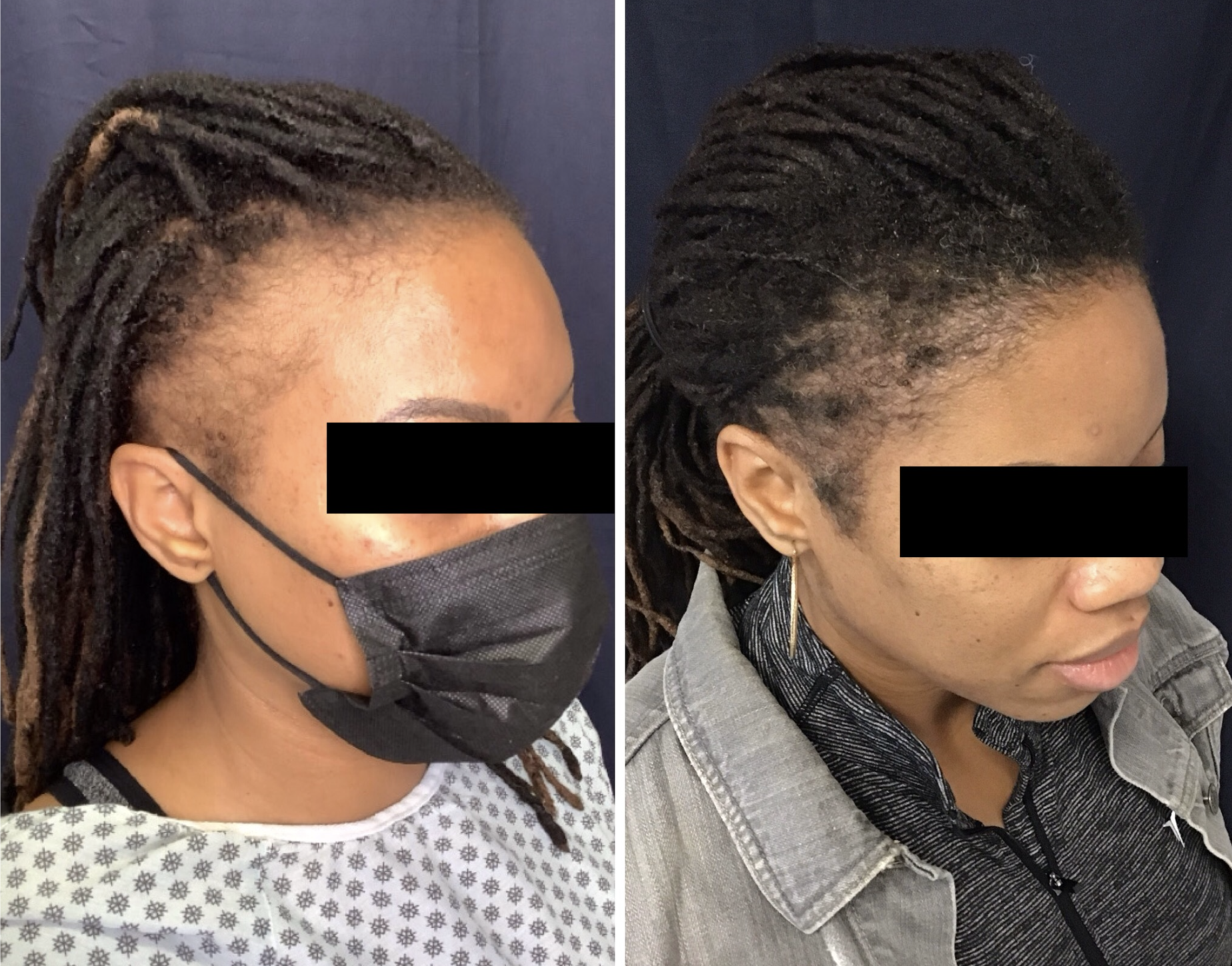 Female Edge & Temple Restoration