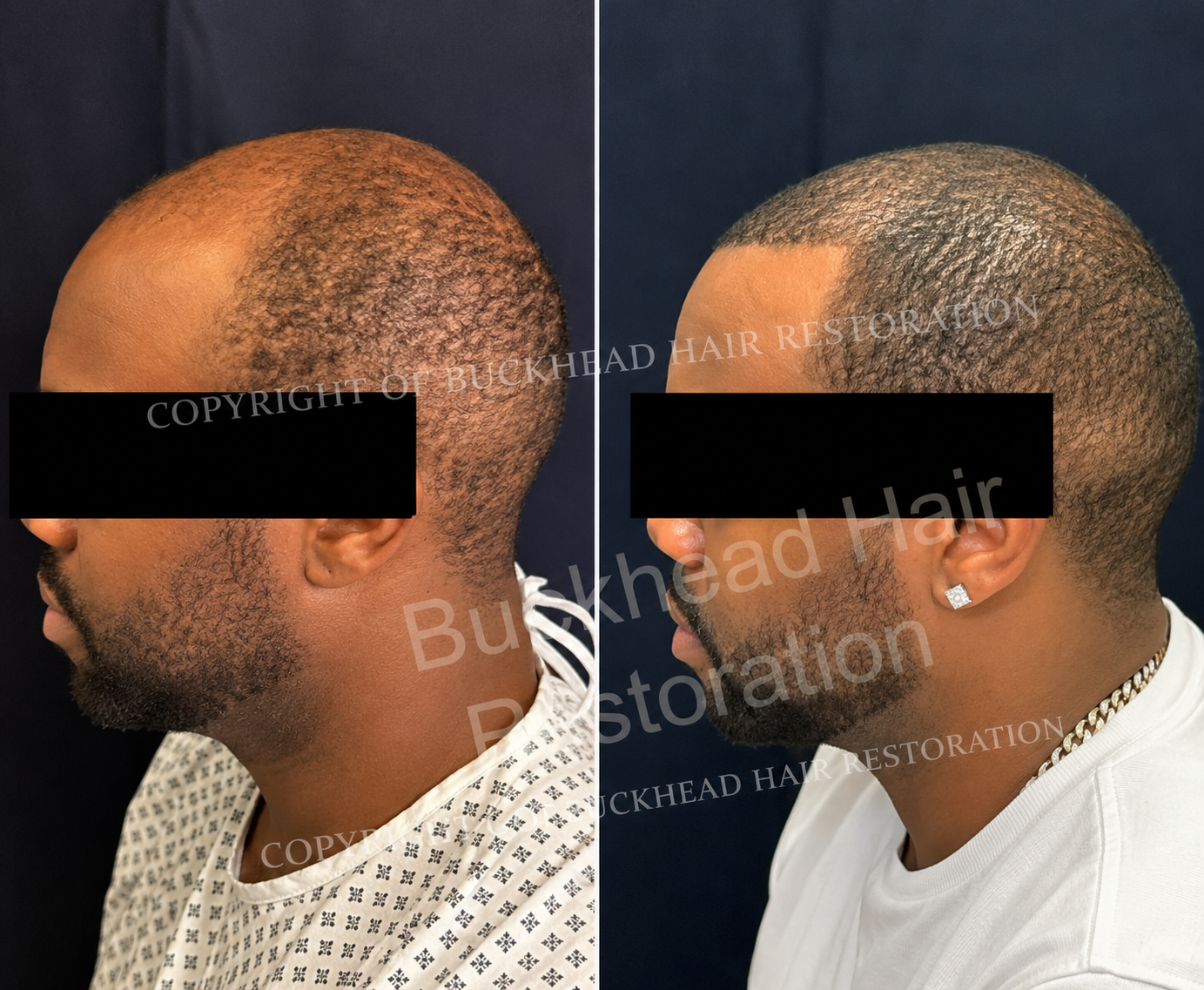 Advanced Hairline & Crown Restoration