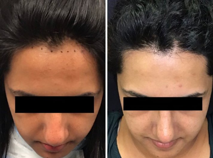 Female Hairline Restoration