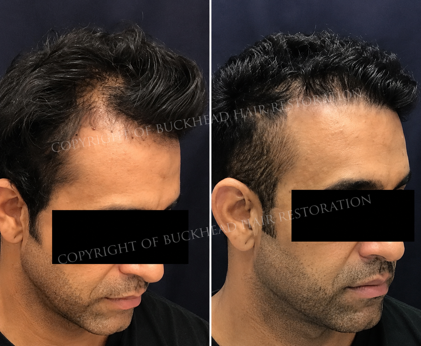 Male Frontal Hairline & Temple Restoration
