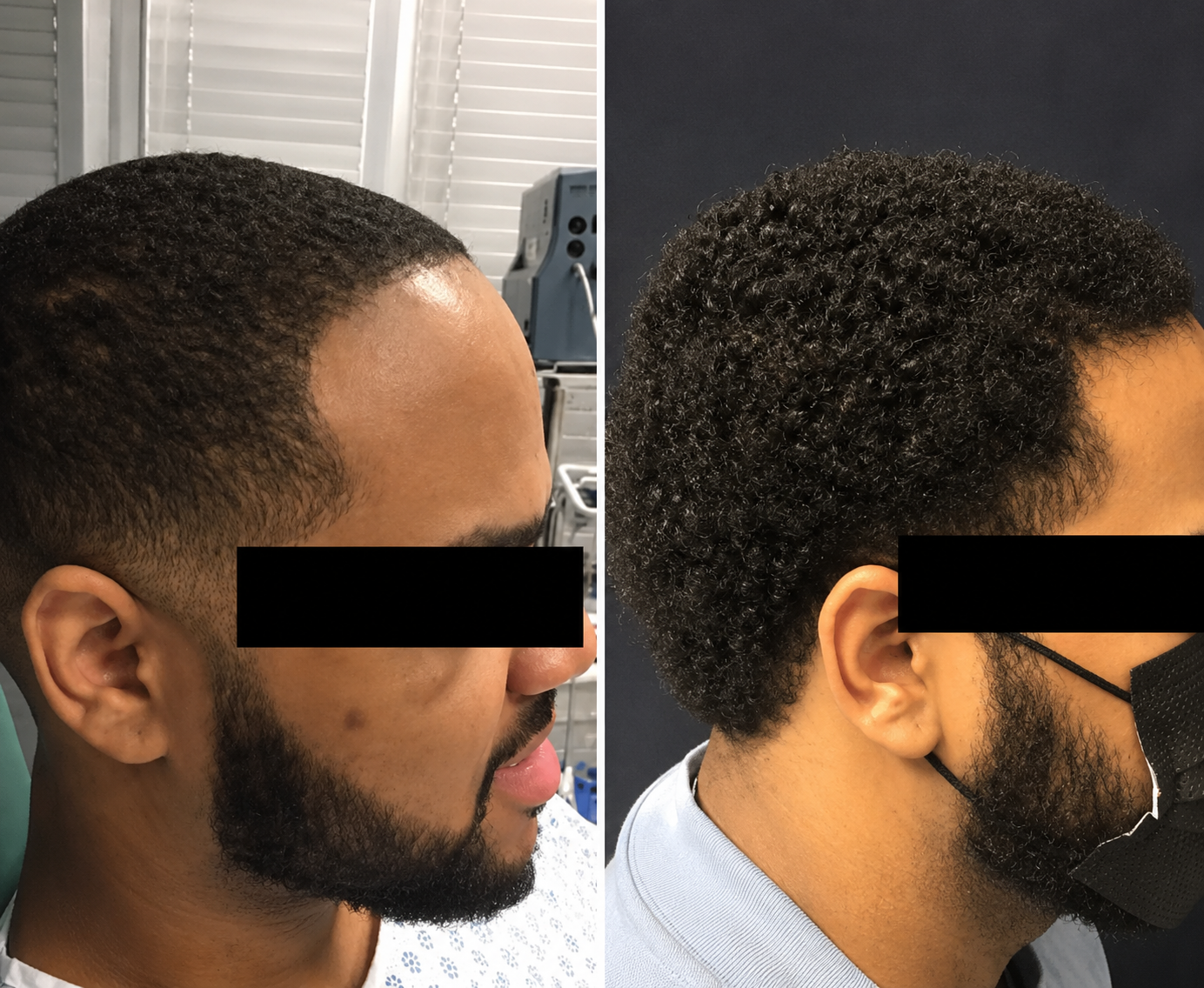 Extensive Frontal Hairline Restoration
